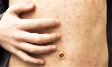 Sarampión: siguen creciendo los contagios en el AMBA